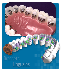 brackets_lingual
