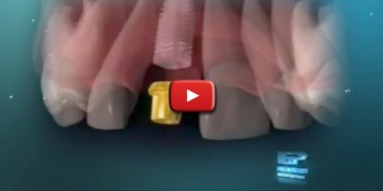 implante_dental_2